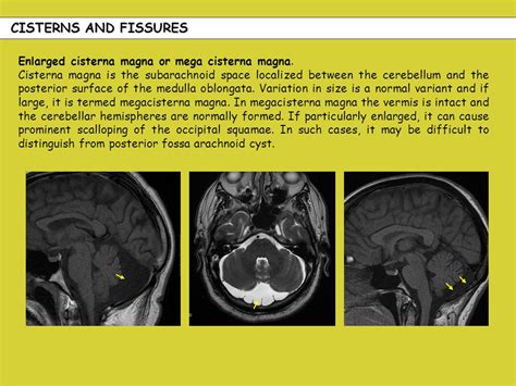 cisterna magna treatment|Mega Cisterna Magna: Understanding a.